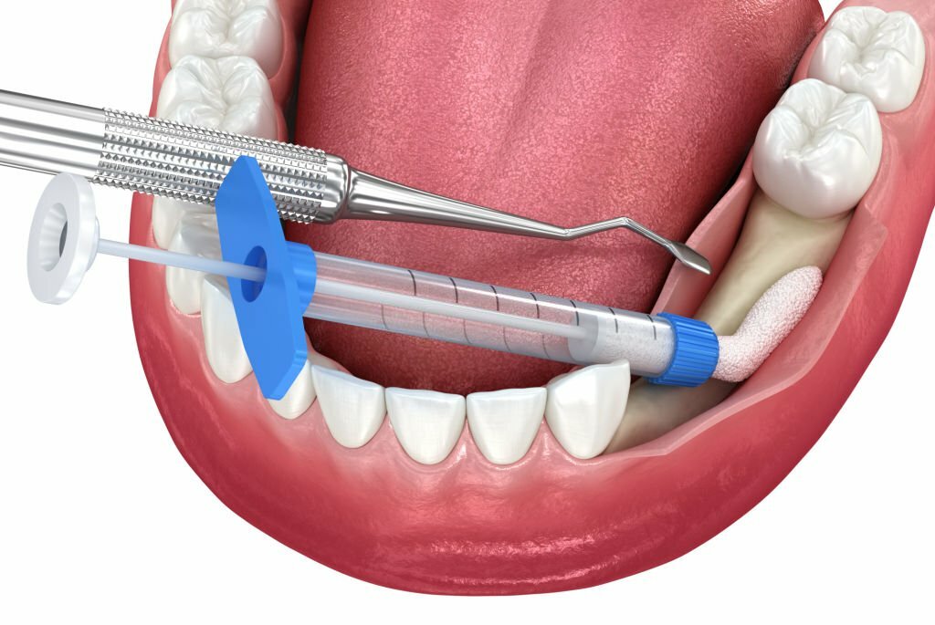 bone grafting in Dwarka