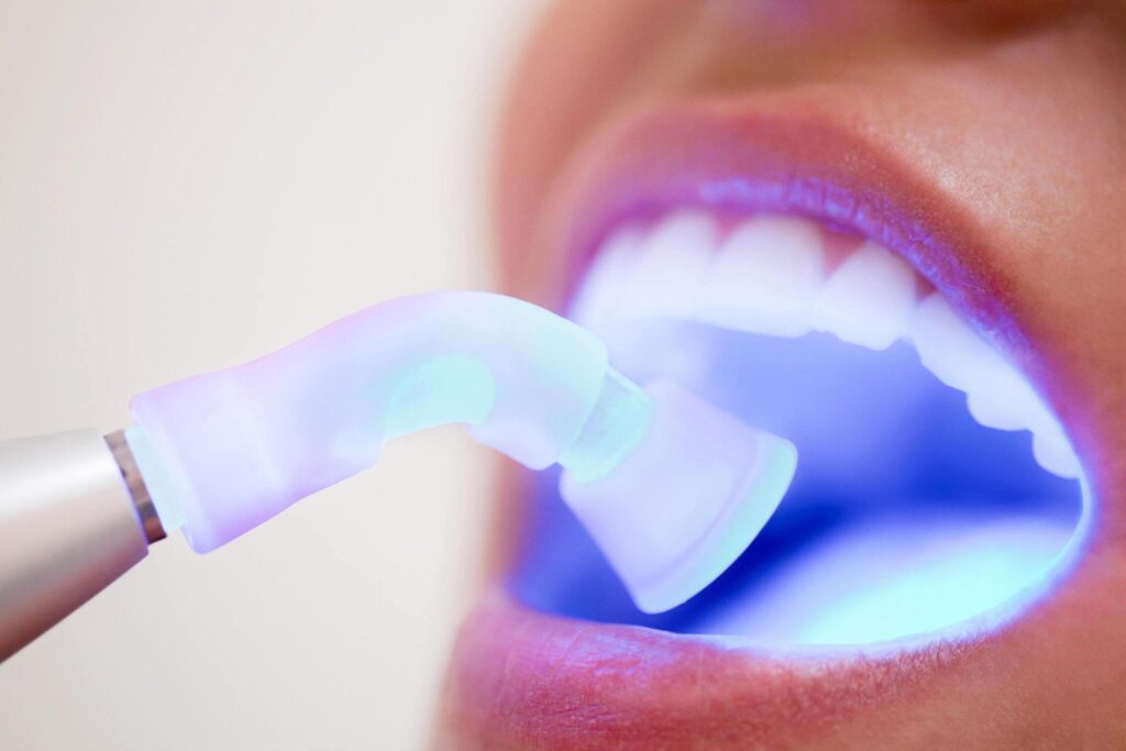 Expert Laser Dentistry in Dwarka