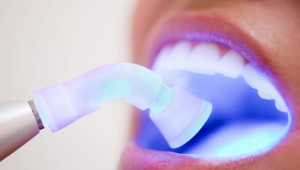 Expert Laser Dentistry in Dwarka