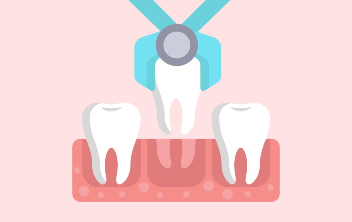 Tooth Extraction: Cost, Procedure and Risks