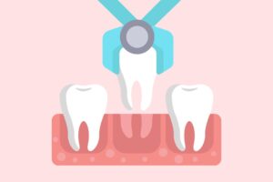 Tooth Extraction: Cost, Procedure and Risks