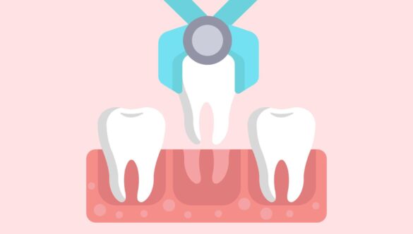 Tooth Extraction: Cost, Procedure and Risks