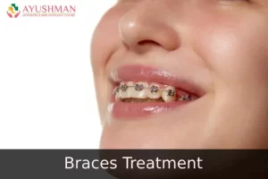 Dental Braces Treatment in Delhi