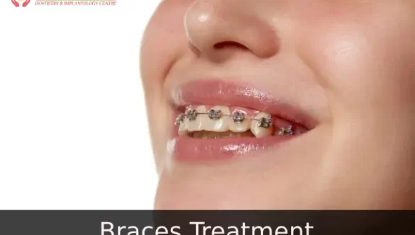 Dental Braces Treatment in Delhi