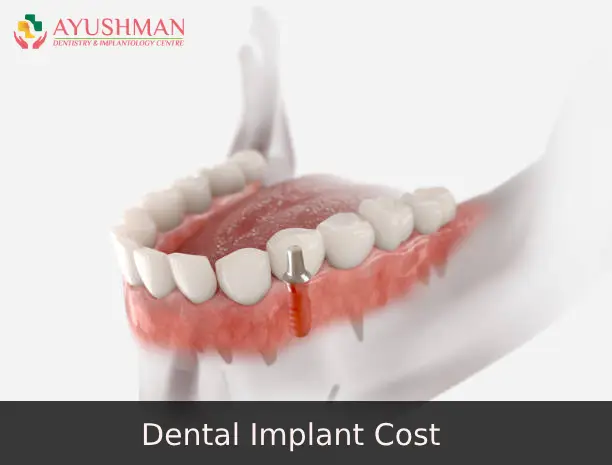 Dental Implant Cost in Dwarka, Delhi