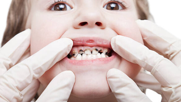 10 Tips to Prevent Tooth Decay In Kids | Kids Health