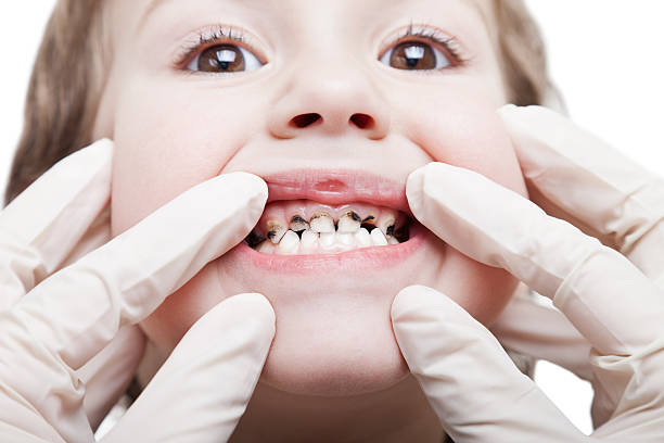 10 Tips to Prevent Tooth Decay In Kids | Kids Health