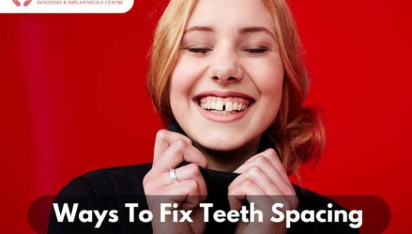 Ways To Fix Teeth Spacing | Ayushman Dentistry