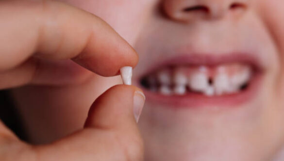 Extraction Of Milk Tooth In Children