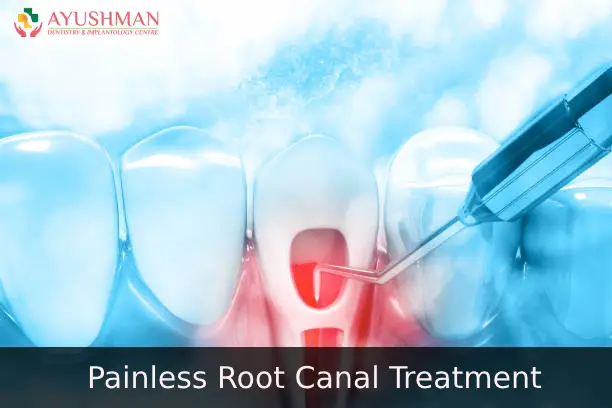 Painless Root Canal Treatment In Dwarka | RCT Cost In Dwarka