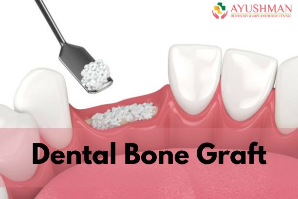 Dental Bone Graft