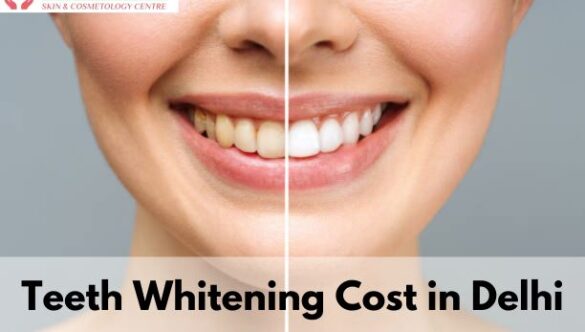 Teeth Whitening Cost in Delhi | Teeth Whitening in Delhi