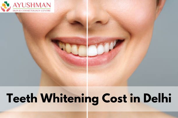 Teeth Whitening Cost in Delhi