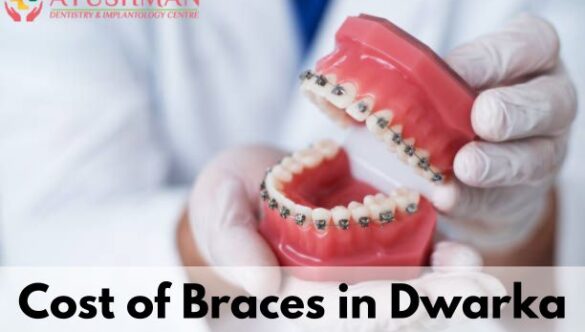 Cost of Braces in Dwarka