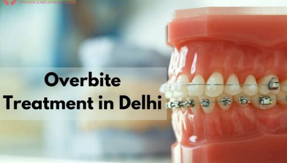 Overbite Treatment in Dwarka