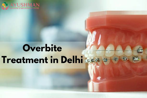 Overbite Treatment in Dwarka