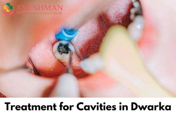 Treatment for Cavities in Dwarka