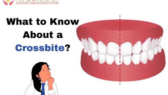 What to Know About a Crossbite?