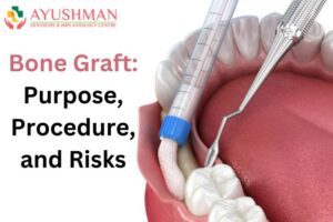 Bone Graft: Purpose, Procedure, and Risks