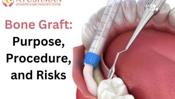 Bone Graft: Purpose, Procedure, and Risks