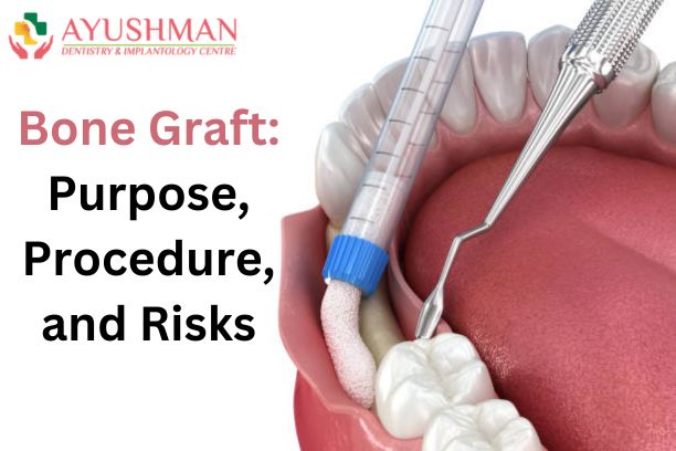 Bone Graft