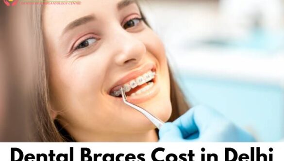 Dental Braces Cost in Delhi