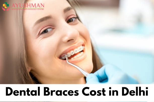 Dental Braces Cost in Delhi