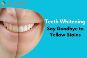 Say Goodbye to Yellow Stains | Teeth Whitening