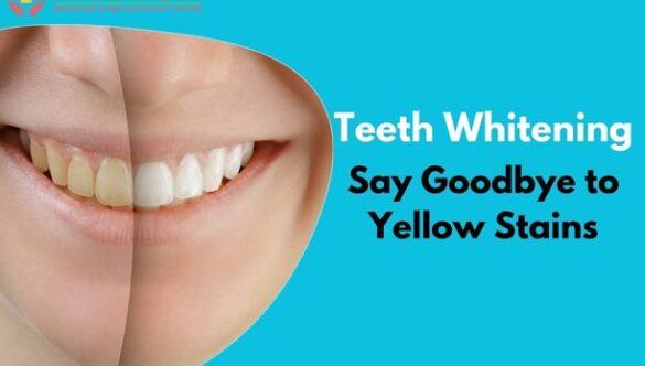 Say Goodbye to Yellow Stains | Teeth Whitening