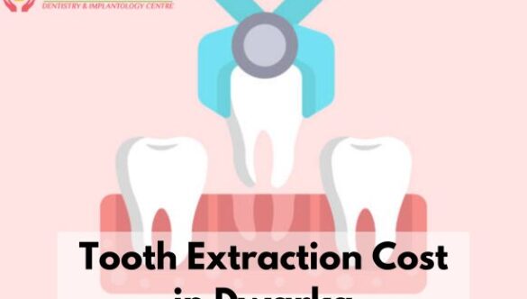 Tooth Extraction Cost in Dwarka