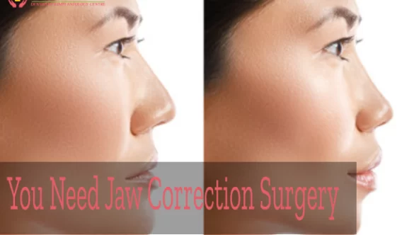 You Need Jaw Correction Surgery – How to Know