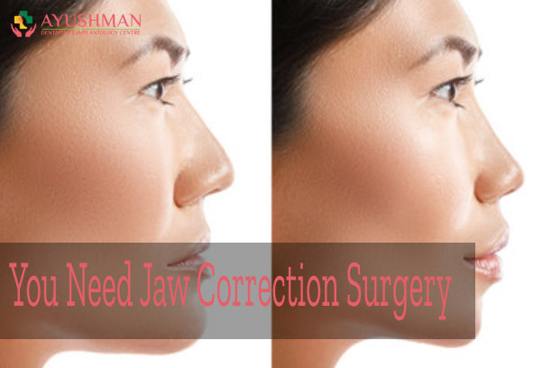 You Need Jaw Correction Surgery – How to Know