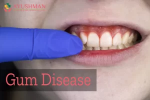 What are the risk factors for Gum Disease?