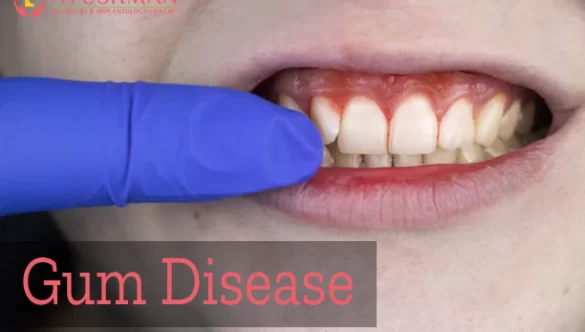 What are the risk factors for Gum Disease?