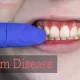 What are the risk factors for Gum Disease?