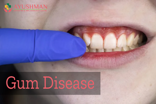 What are the risk factors for Gum Disease?