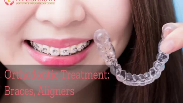 Orthodontic Treatment: Braces, Aligners, and More